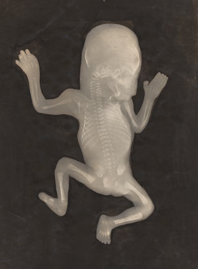 Degree of Ossification of a Five-Month-Old Fetus by Unknown