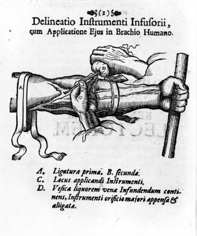 Intravenous injection using a clystery bladder. by J. D. Mayor, 