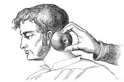 Local bleeding - application of leeches with an apple - engraving in 