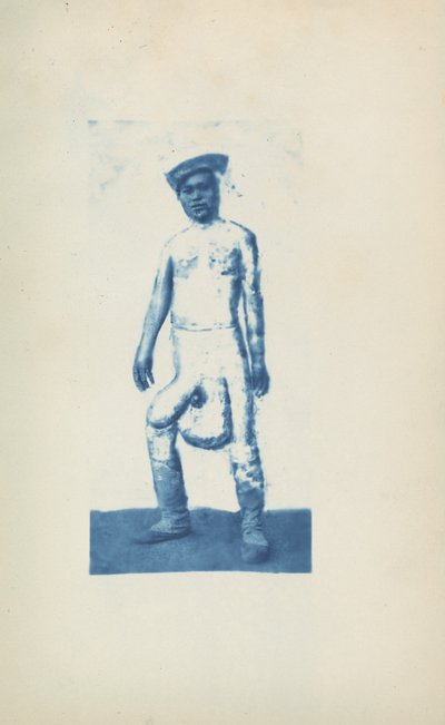 Elephantiasis, c. 1870s by Unknown photographer
