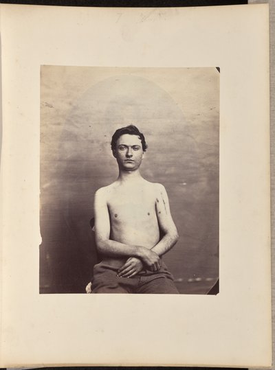 Recovery after Excision of the Head of the Left Humerus for Gunshot Fracture by William H. Bell