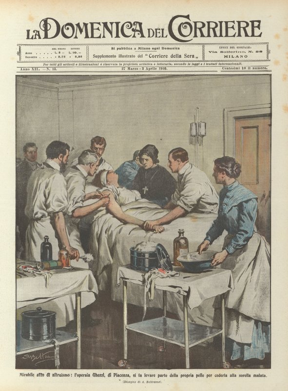 Wonderful act of altruism, the worker Ghezzi, from Piacenza, has part of her own skin removed by Achille Beltrame