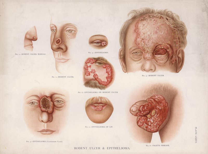 Diseases of the Skin: Rodent Ulcer and Epithelioma by English School