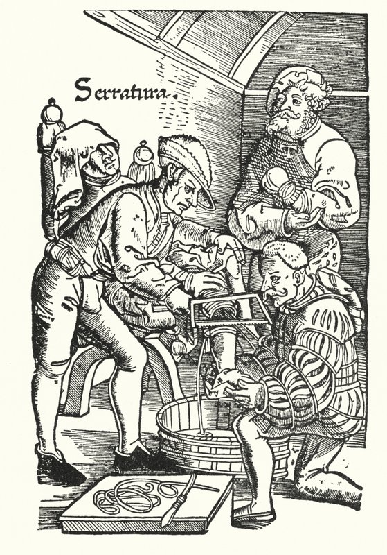 Amputation in the sixteenth century by European School