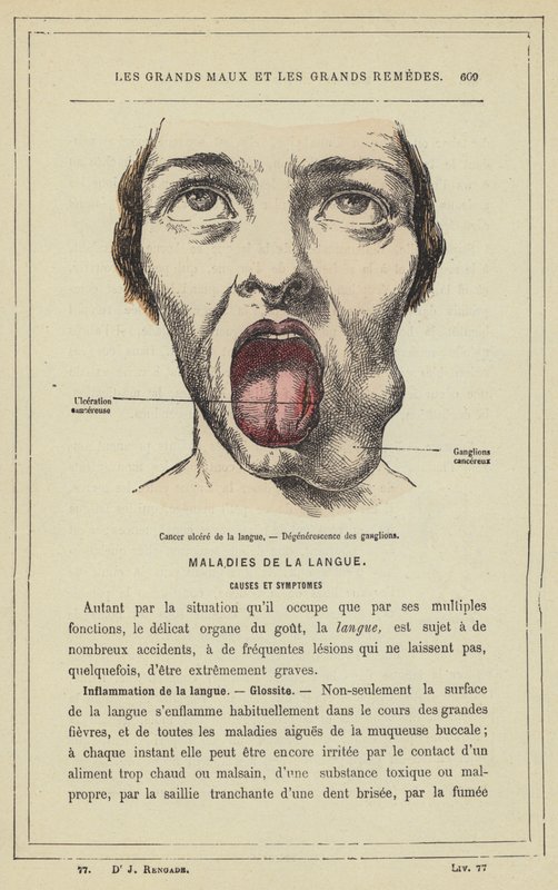 Ulcerated Cancer of the Tongue, Degeneration of the Glands — free download