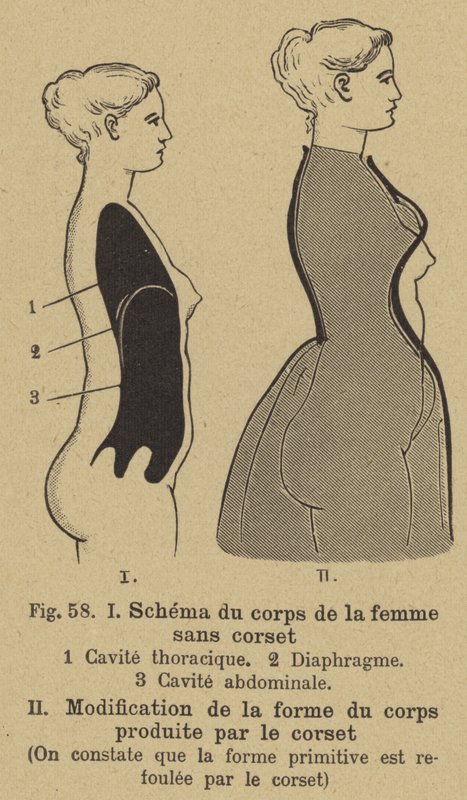 Diagram showing the effect of wearing a corset on the shape of a woman