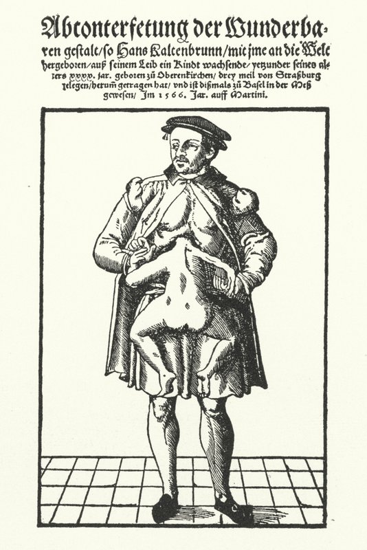 Hans Kaltenbrunn and his undeveloped conjoined twin (engraving) by German School