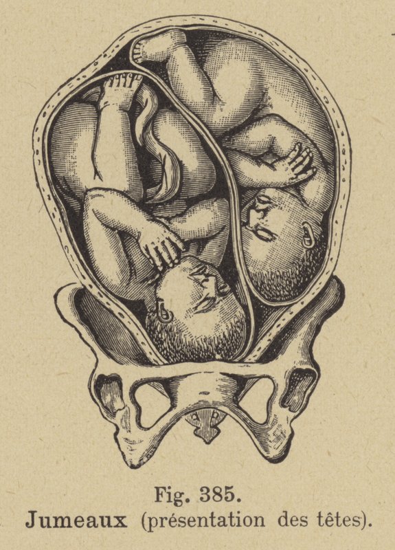 絵画 the memory in the womb C. 1860 TWINS IN WOMB Lithograph • Original Antique Print