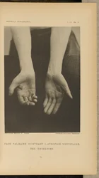 Palmar Face Showing Muscular Atrophy of the Eminences
