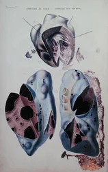 Apoplexy of the heart and of the lungs, illustration plate from Anatomie pathologique du corps humain by Jean Cruveilhier (1791-1874), published in Paris