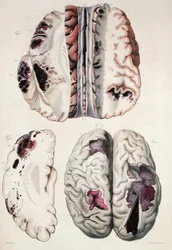 Capillary apoplexy, from 