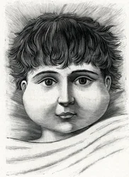 Child with mumps disease (engraving) 1888