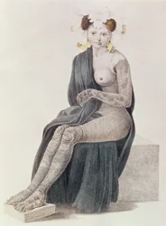 Congenital Ichthyosis, from a Book by G.M. Olbers, 1830