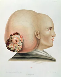 Fungus of the Dura Mater, from Selecta Praxis Medico-Chirurgica by Alexander Auvert