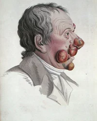 Mycosis Fongoide, from a book by Baron Jean Louis Alibert