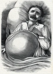 Patient with advanced liver cirrhosis (engraving) 1888