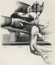 Resection of the Shoulder (from 