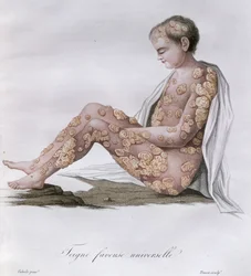 Ringworm, from a Book by Baron Jean Louis Alibert, 1838