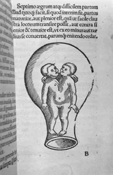 Siamese children, illustration from the so-called Rhodion manuscript