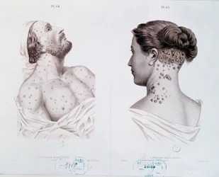 Symptoms of syphilis in men and women, from a medical book, c.1850-60