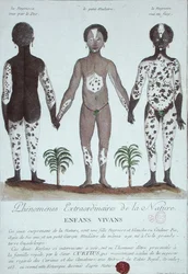 The Phenomenon of Leukoderma