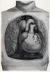 Aneurysm rupture 1888