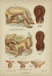 Childbirth