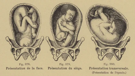 Malpresentation of Babies in the Womb Before Birth
