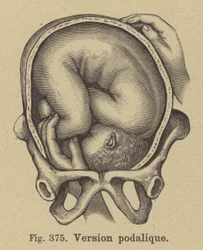 Podalic Version During Childbirth