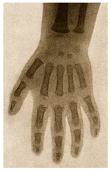 X Ray of a Child