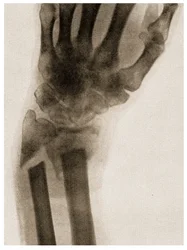 X Ray of a Fractured Wrist