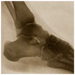 X Ray of an Ankle