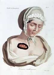 Anthracine Cancer
