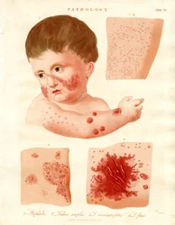 Pathological Skin Diseases