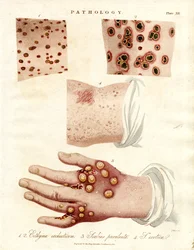 Skin Diseases: Ecthyma, Purulent Scabies, and Smallpox