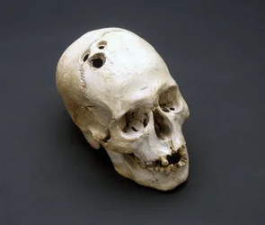 Trephinated Bronze Age skull, Jericho, Palestine, 2200-2000 BC