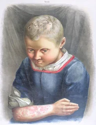 Favus, from a Book by Daniel Cornelius Danielssen, 1892