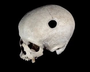 Prehistoric skull with trace of trepanation, Museum of National Antiquities