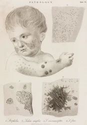 Types of Skin Disease