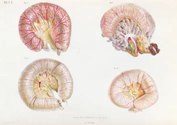 The external surface of the intestines infected with cholera, from Anatomie Pathologique du Cholera Morbus, by Nikolai Ivanovich Pirogov published in St. Petersburg, 1849