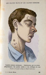 Symptoms of the Tertiary Phase of Syphilis, 19th Century