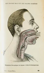 Using a Laryngoscope to Aid the Removal of a Polyp from the Throat
