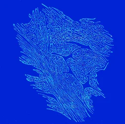 Crossing section of fibro-nucleated tumors