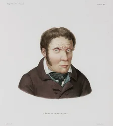 Diseases, Leprosy