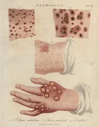 Skin Ulcer and Scabies