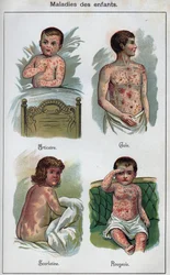 Diseases of children: Hives, Measles, scabies, scarlet fever. In 
