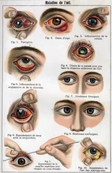 Diseases of the Eye. 