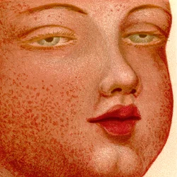 Eruptive Fevers: Scarlatina or Scarlet Fever