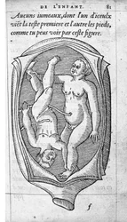 The position of the fetus in the uterus during pregnancy. Engraving from “De la generation des enfants” by French doctor and surgeon Ambroise Pare (1509-1590) 16th century