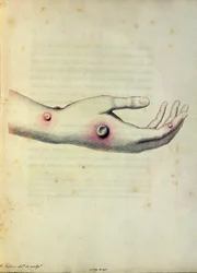 Cowpox pustule on the arm of Sarah Nelmes, from 